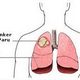 Illustration for article titled Buah Untuk Penyakit Paru Paruem/em